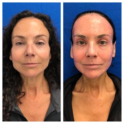 Renuvion Resurfacing Before & After Gallery - Patient 151876 - Image 1