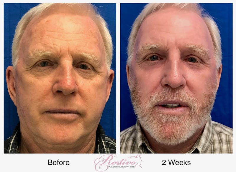 Renuvion Resurfacing Before & After Gallery - Patient 203876 - Image 1
