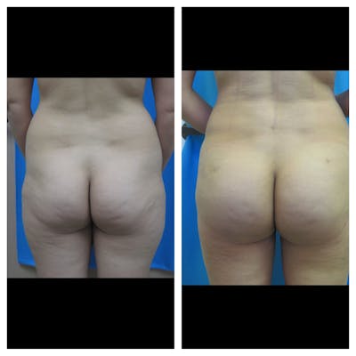 Fat Transfer Before & After Gallery - Patient 625474 - Image 1