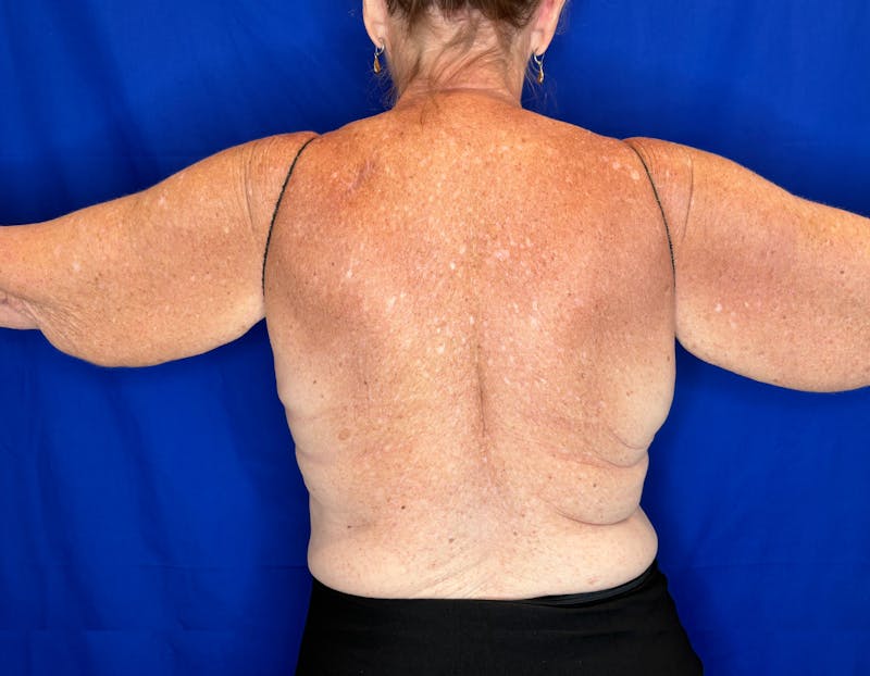 Arm Lift Before & After Gallery - Patient 197066 - Image 3