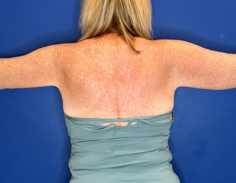 Arm Lift Before & After Gallery - Patient 197066 - Image 4