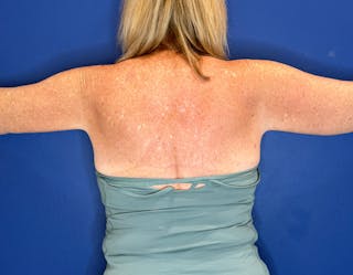 Arm Lift Before & After Gallery - Patient 197066 - Image 4