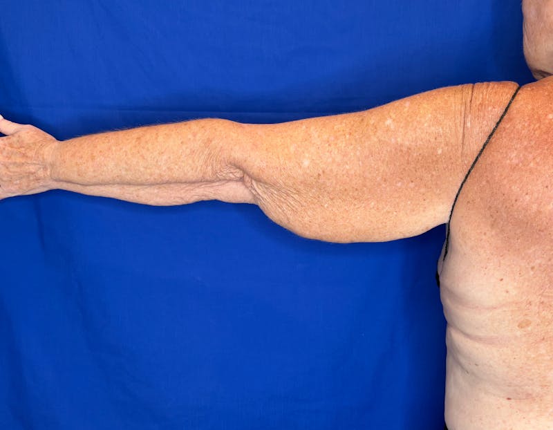 Arm Lift Before & After Gallery - Patient 197066 - Image 1