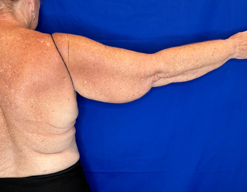 Arm Lift Before & After Gallery - Patient 197066 - Image 5