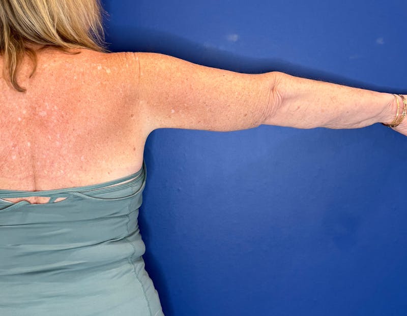 Arm Lift Before & After Gallery - Patient 197066 - Image 6