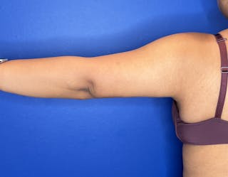 Arm Lift Before & After Gallery - Patient 269079 - Image 2