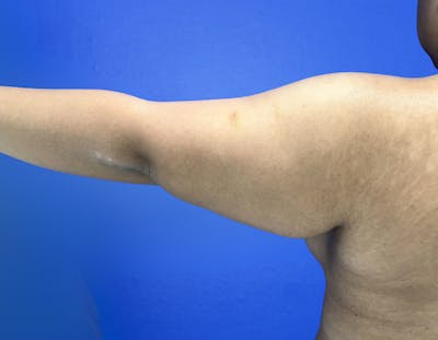Arm Lift Before & After Gallery - Patient 269079 - Image 1