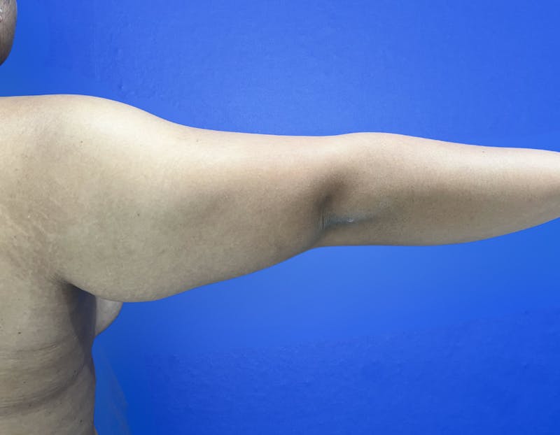Arm Lift Before & After Gallery - Patient 269079 - Image 3