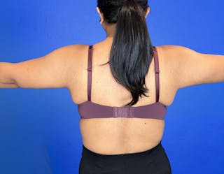Arm Lift Before & After Gallery - Patient 269079 - Image 6