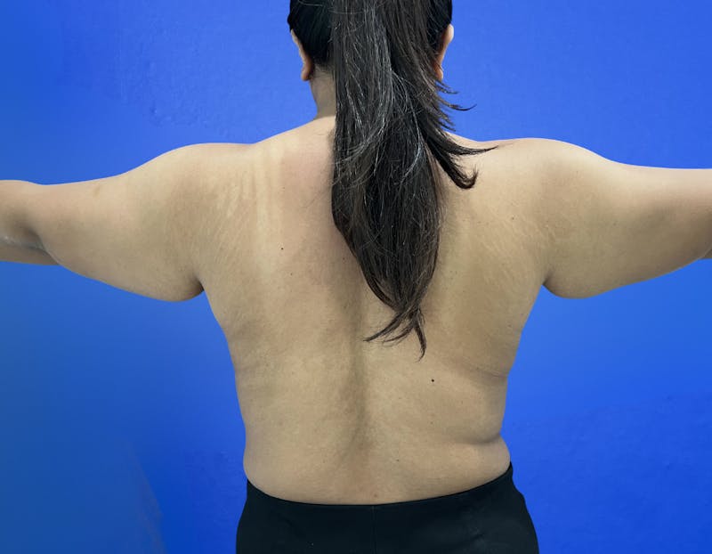 Arm Lift Before & After Gallery - Patient 269079 - Image 5