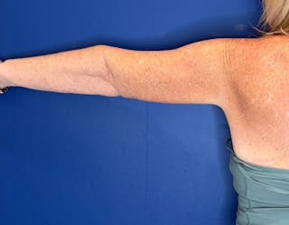 Arm Lift Before & After Gallery - Patient 197066 - Image 2