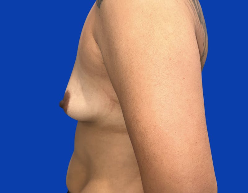 Breast Augmentation Before & After Gallery - Patient 916601 - Image 5