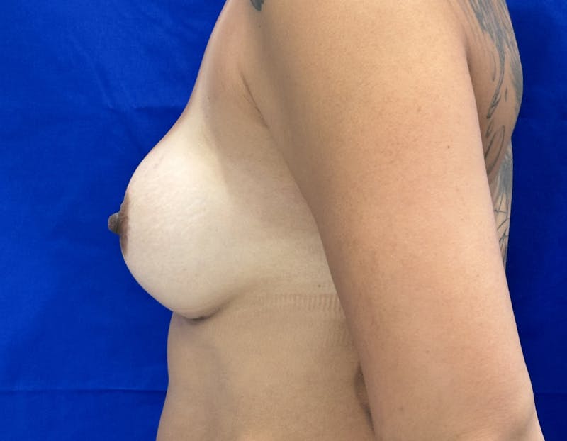 Breast Augmentation Before & After Gallery - Patient 916601 - Image 6