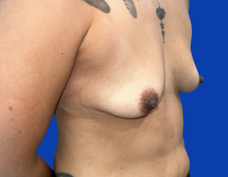 Breast Augmentation Before & After Gallery - Patient 916601 - Image 3