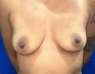 Breast Augmentation Before & After Gallery - Patient 387297 - Image 1