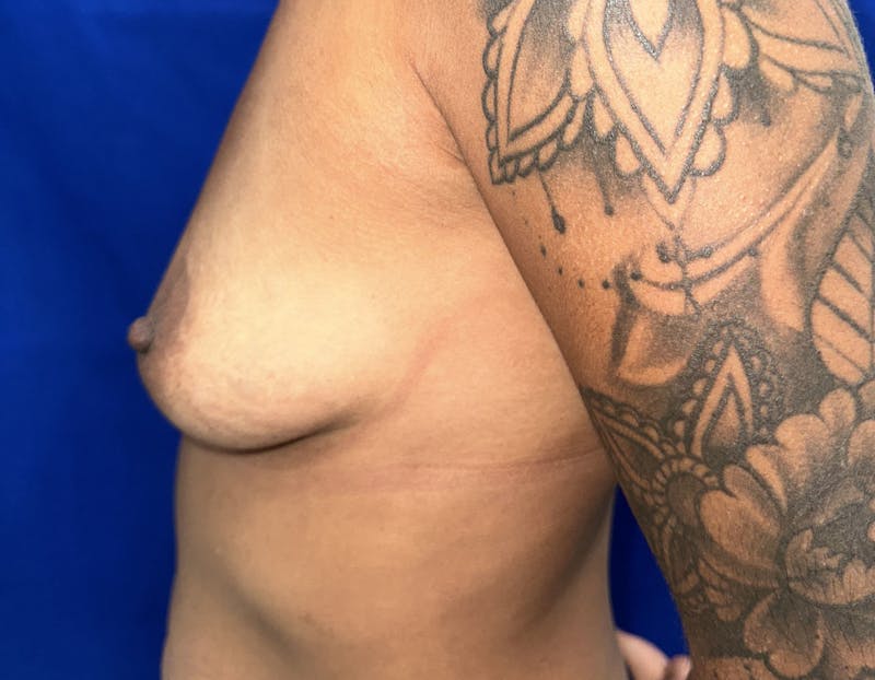 Breast Augmentation Before & After Gallery - Patient 387297 - Image 7