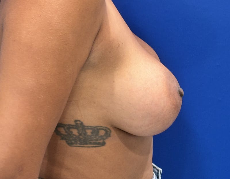 Breast Augmentation Before & After Gallery - Patient 387297 - Image 4