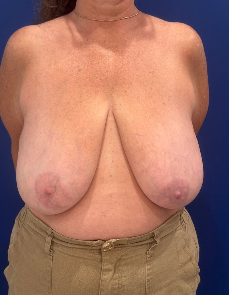 Breast Lift Before & After Gallery - Patient 106700 - Image 1