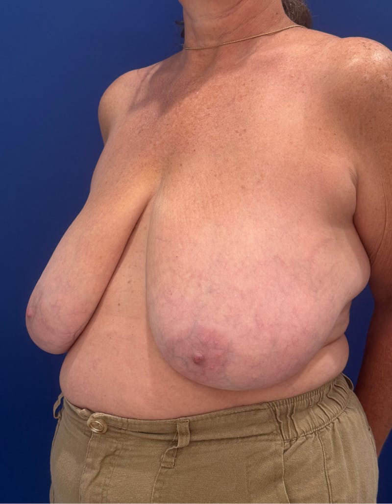 Breast Lift Before & After Gallery - Patient 106700 - Image 5