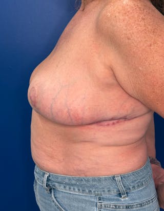 Breast Lift Before & After Gallery - Patient 106700 - Image 4