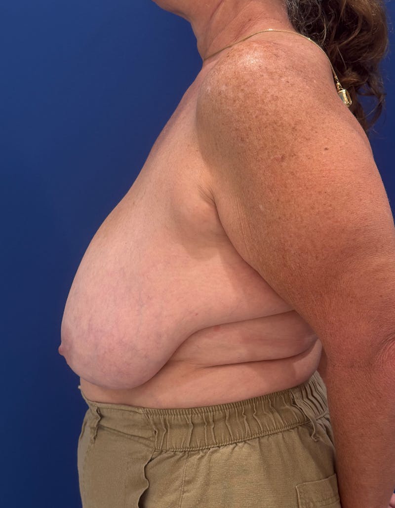 Breast Lift Before & After Gallery - Patient 106700 - Image 3