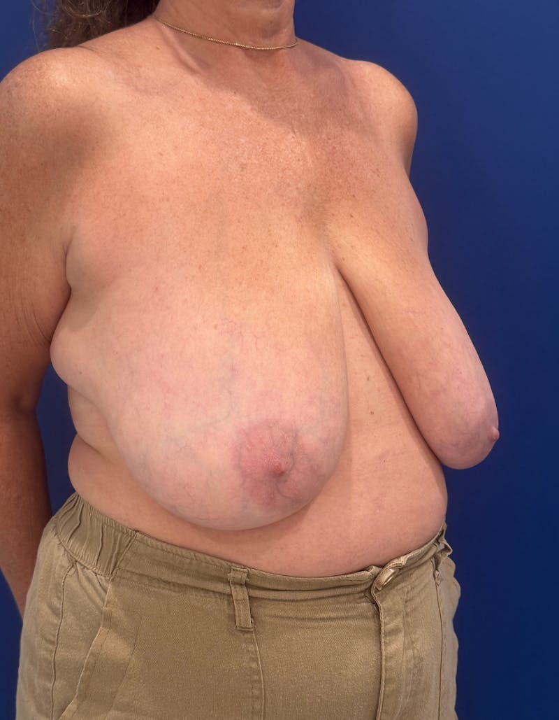 Breast Lift Before & After Gallery - Patient 106700 - Image 7