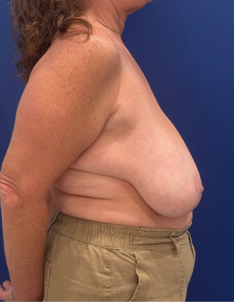 Breast Lift Before & After Gallery - Patient 106700 - Image 9