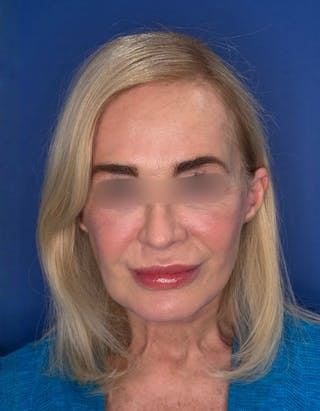 Brow Lift Before & After Gallery - Patient 134846 - Image 2