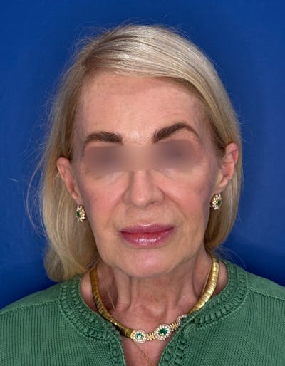 Laser Resurfacing Before & After Gallery - Patient 404816 - Image 1