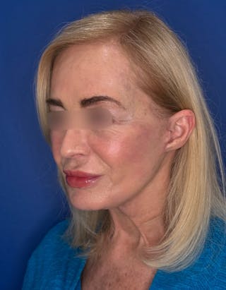Brow Lift Before & After Gallery - Patient 134846 - Image 4