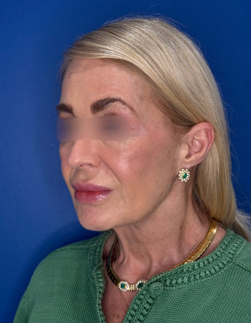 Laser Resurfacing Before & After Gallery - Patient 404816 - Image 3