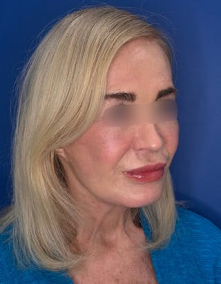 Brow Lift Before & After Gallery - Patient 134846 - Image 8