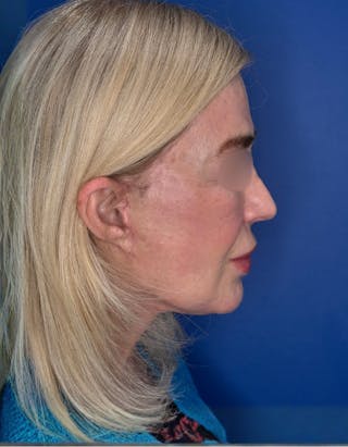 Brow Lift Before & After Gallery - Patient 134846 - Image 10