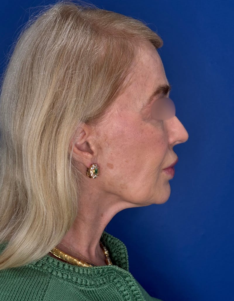 Laser Resurfacing Before & After Gallery - Patient 404816 - Image 9