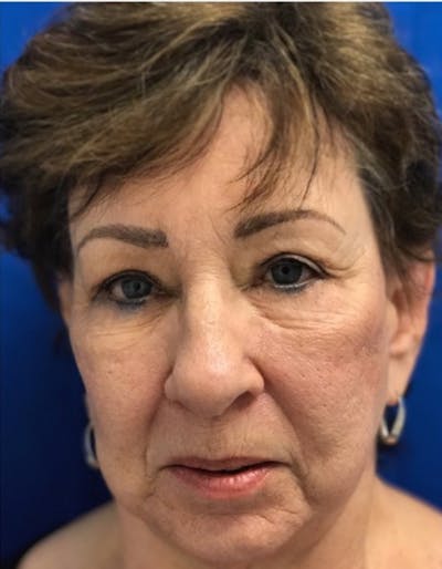 Laser Resurfacing Before & After Gallery - Patient 114311 - Image 1