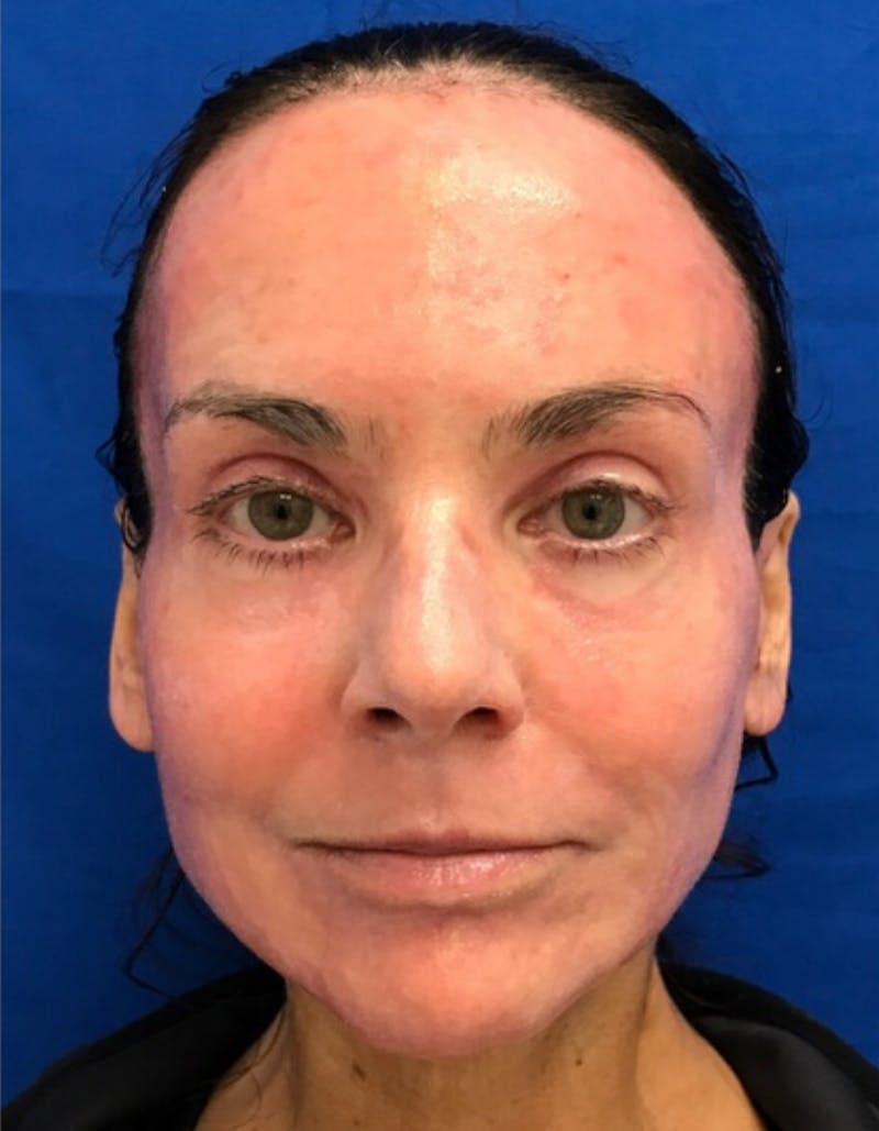 Laser Resurfacing Before & After Gallery - Patient 213208 - Image 2