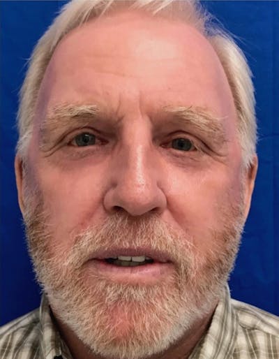 Laser Resurfacing Before & After Gallery - Patient 220437 - Image 2