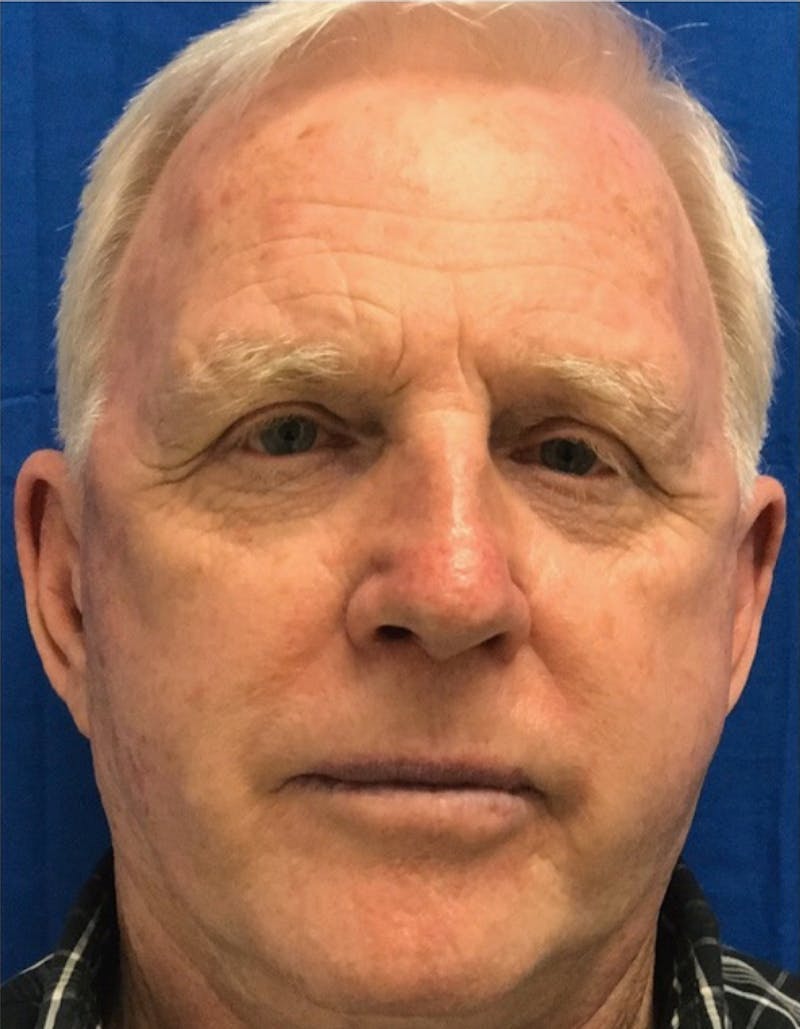 Laser Resurfacing Before & After Gallery - Patient 220437 - Image 1