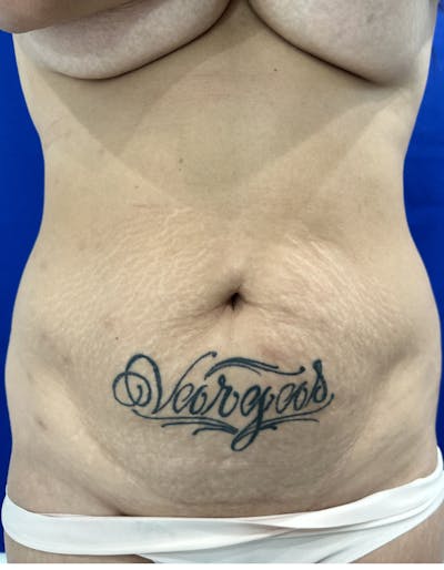 Tummy Tuck Before & After Gallery - Patient 165709 - Image 1