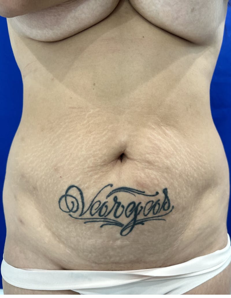 Tummy Tuck Before & After Gallery - Patient 165709 - Image 1