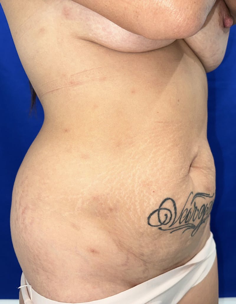 Tummy Tuck Before & After Gallery - Patient 165709 - Image 5