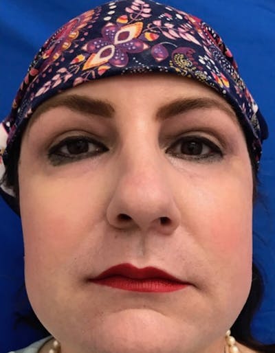 Laser Resurfacing Before & After Gallery - Patient 230779 - Image 2