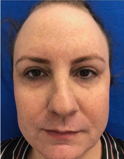 Laser Resurfacing Before & After Gallery - Patient 230779 - Image 1