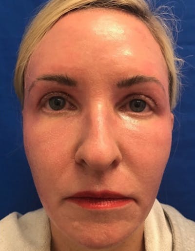 Laser Resurfacing Before & After Gallery - Patient 607416 - Image 2