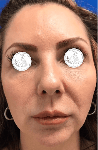 Laser Resurfacing Before & After Gallery - Patient 359257 - Image 1