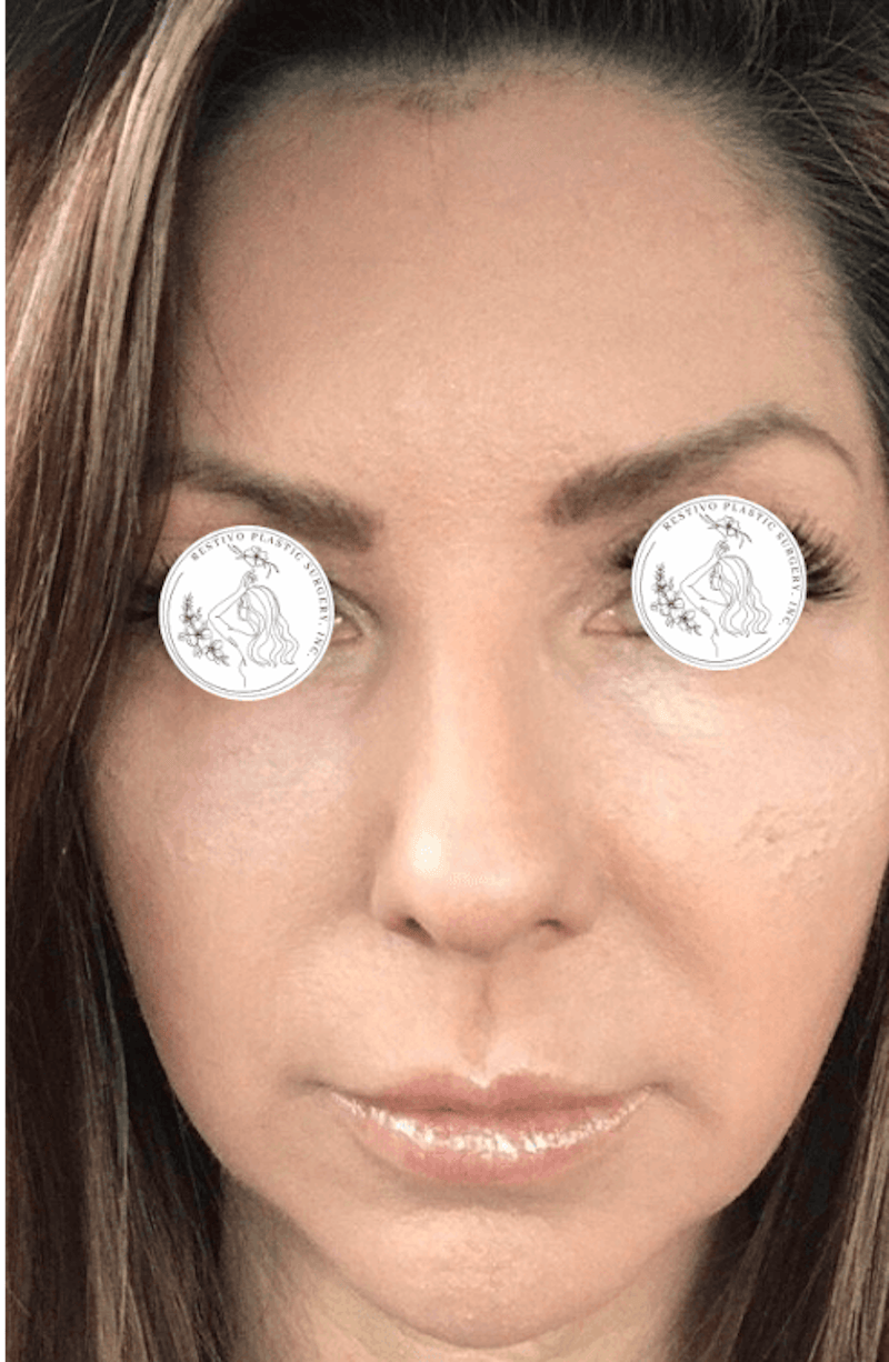 Laser Resurfacing Before & After Gallery - Patient 359257 - Image 2