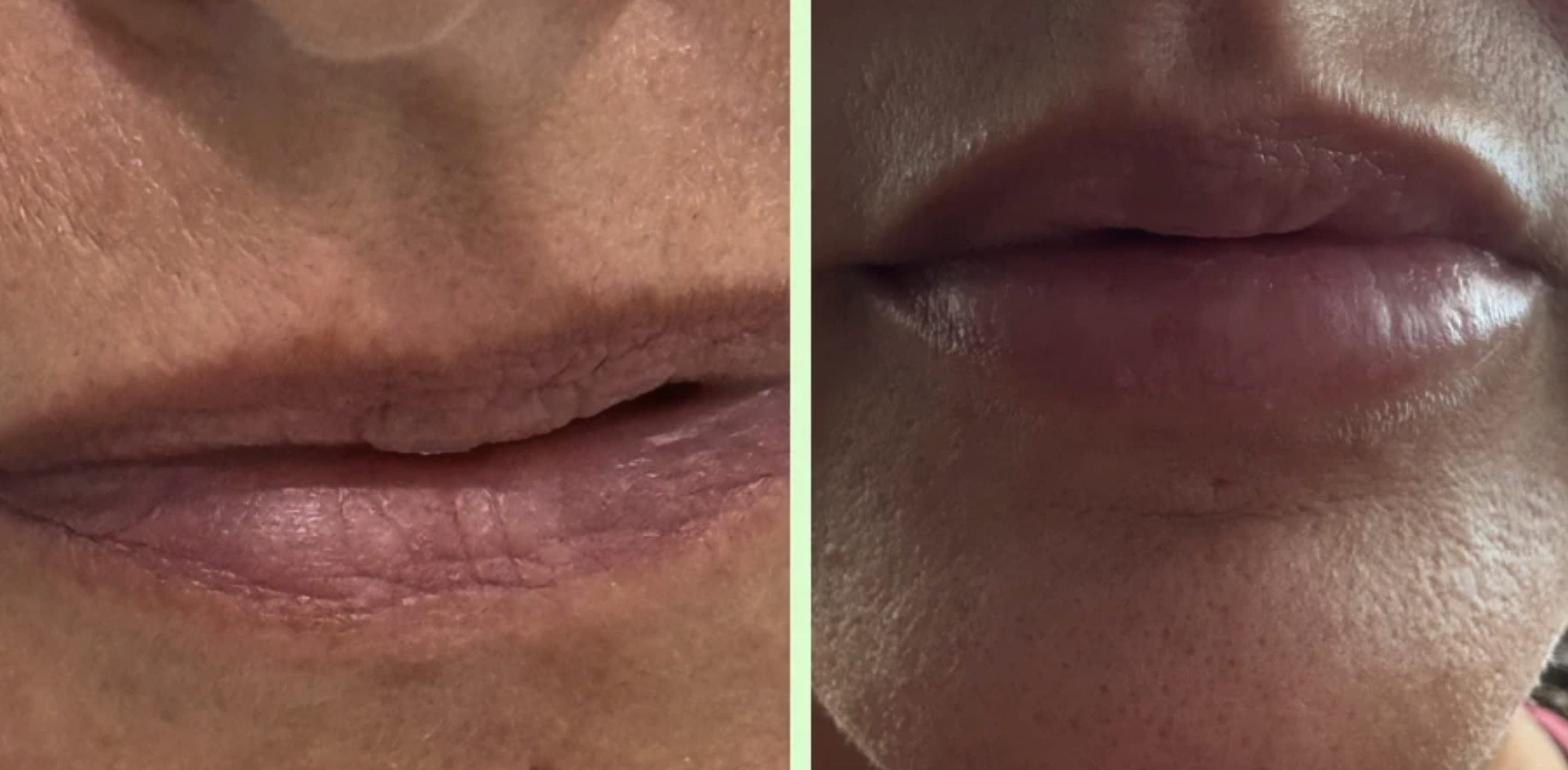 Before and after lip results thin lips vs full lips