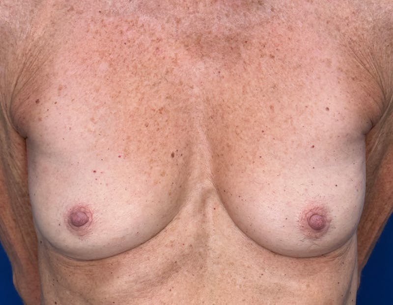 Breast Augmentation Before & After Gallery - Patient 164766 - Image 1