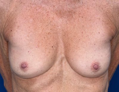 Breast Augmentation Before & After Gallery - Patient 164766 - Image 1