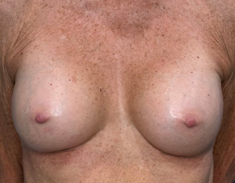 Breast Augmentation Before & After Gallery - Patient 164766 - Image 2